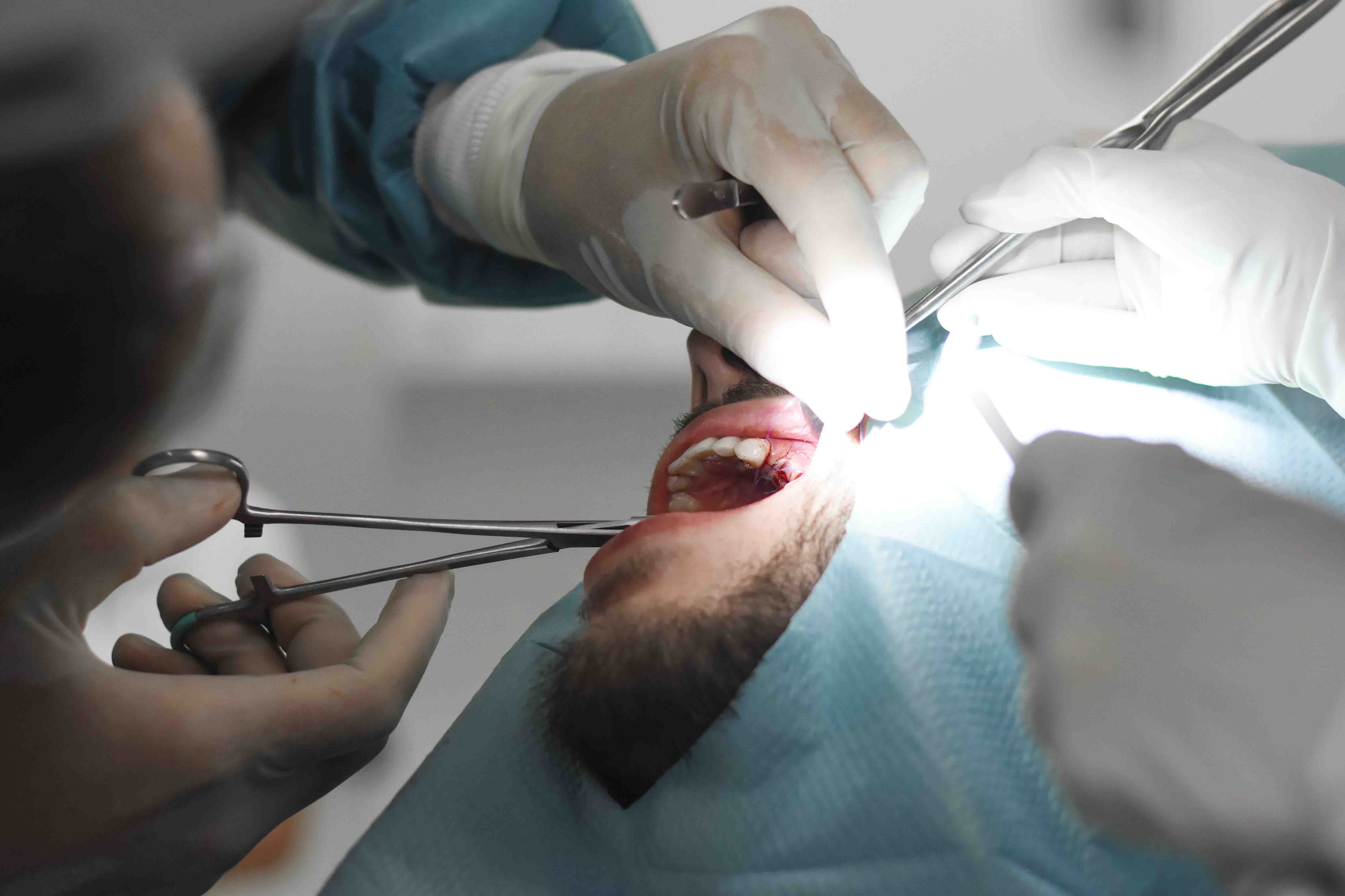 autotransplantation-teeth